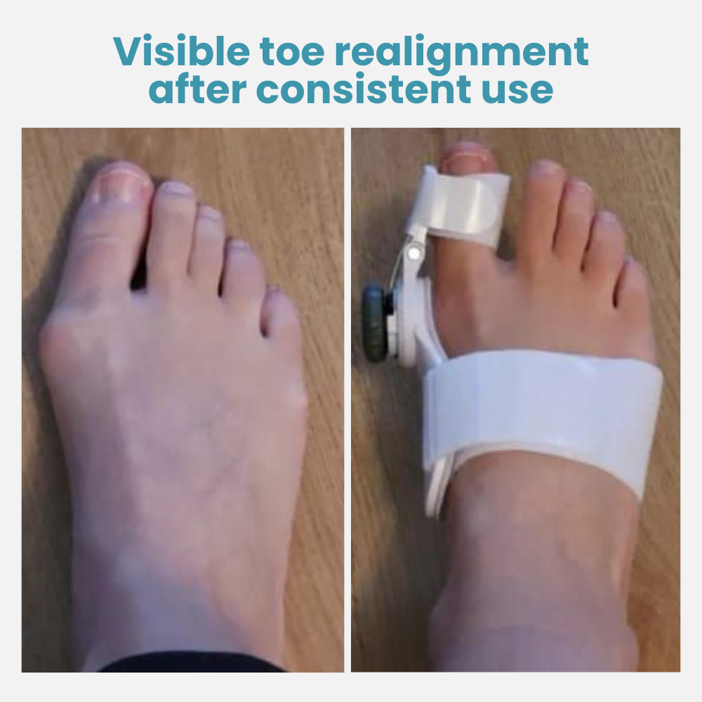 StrideRight — Break Free from Bunion Pain and Step into Comfort All Day