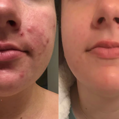 LumaSilk — Clear Away Scars and Glow with Unstoppable Confidence Every Day (1+1 free)